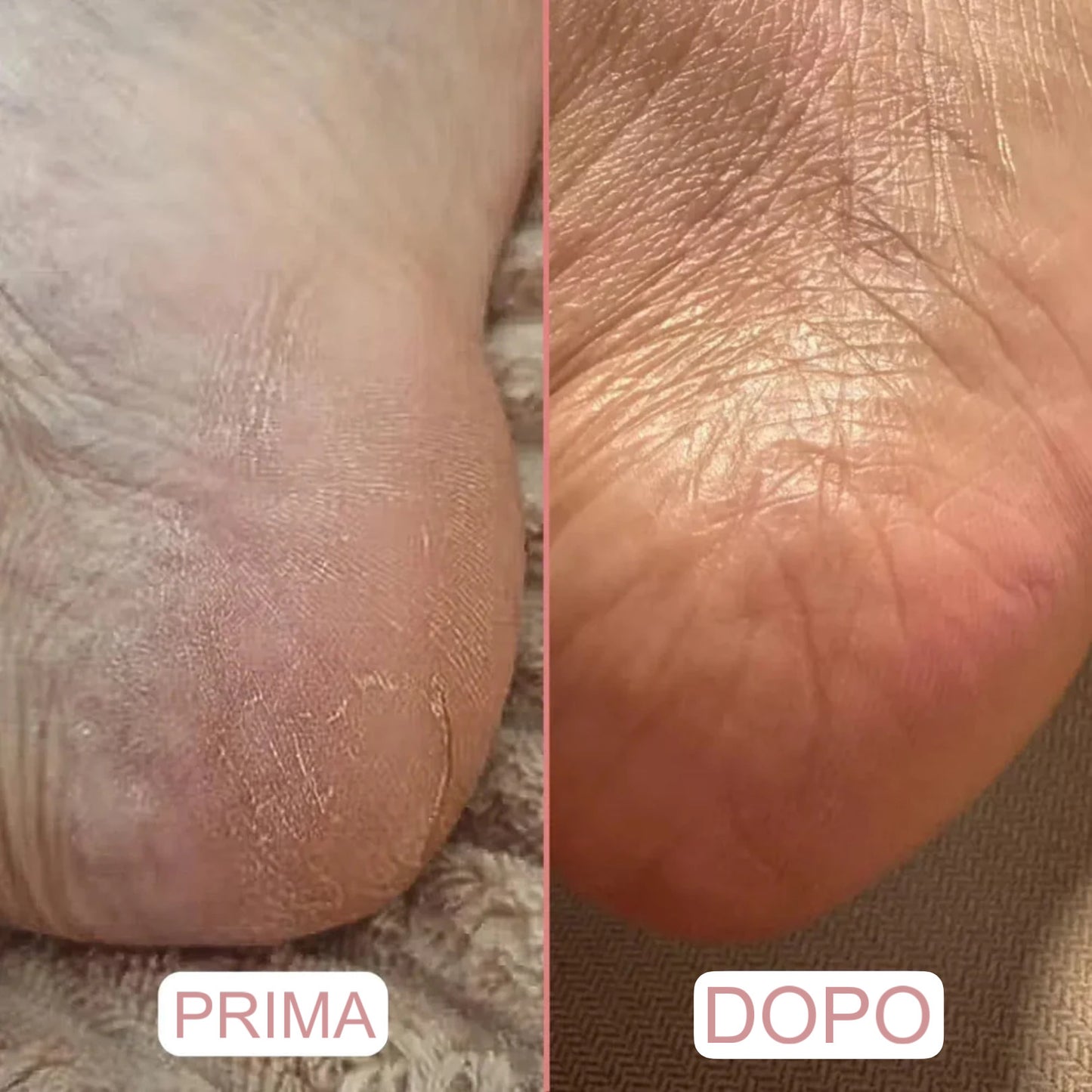 Rimuovi Calli Elettrico