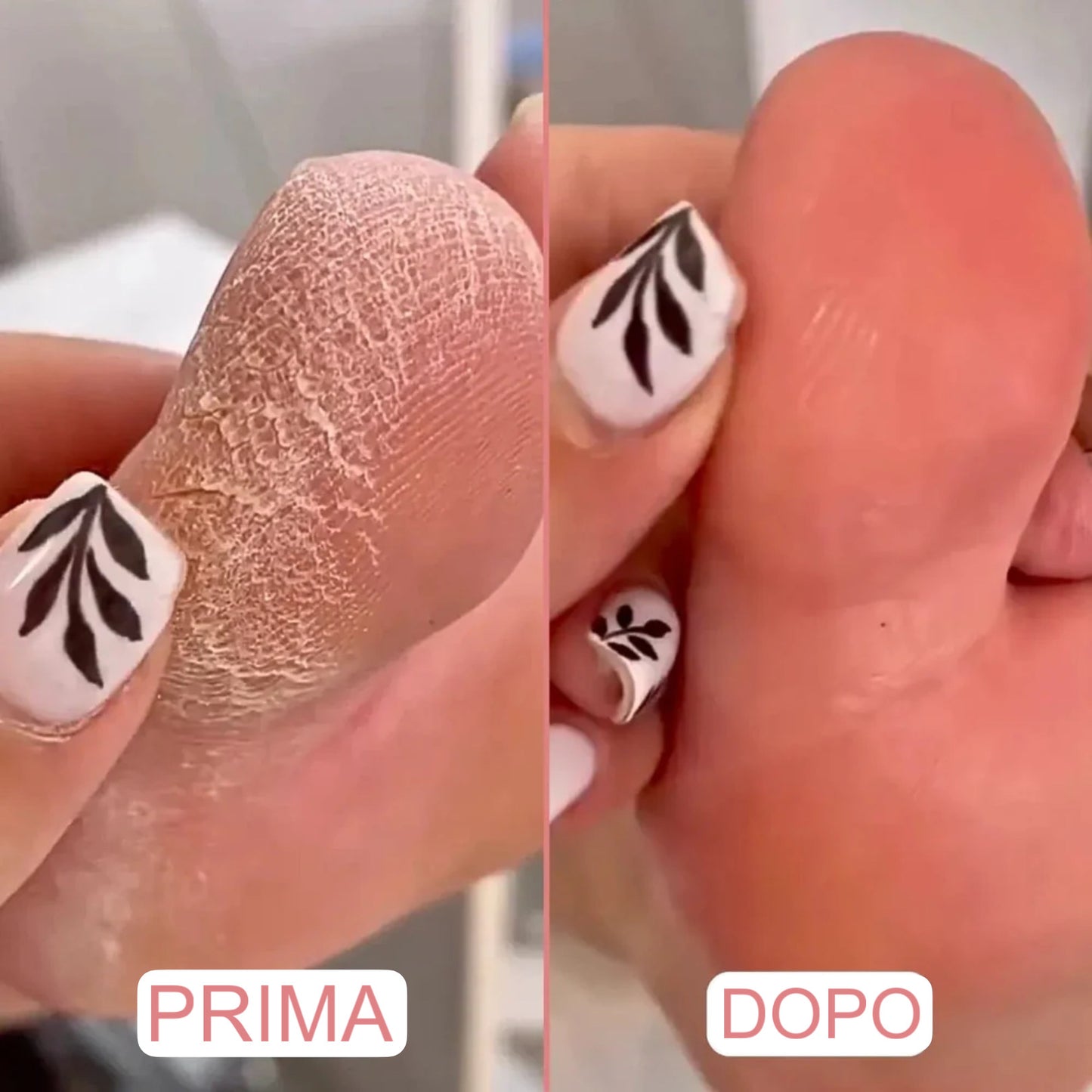 Rimuovi Calli Elettrico