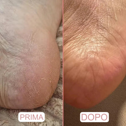 Rimuovi Calli Elettrico